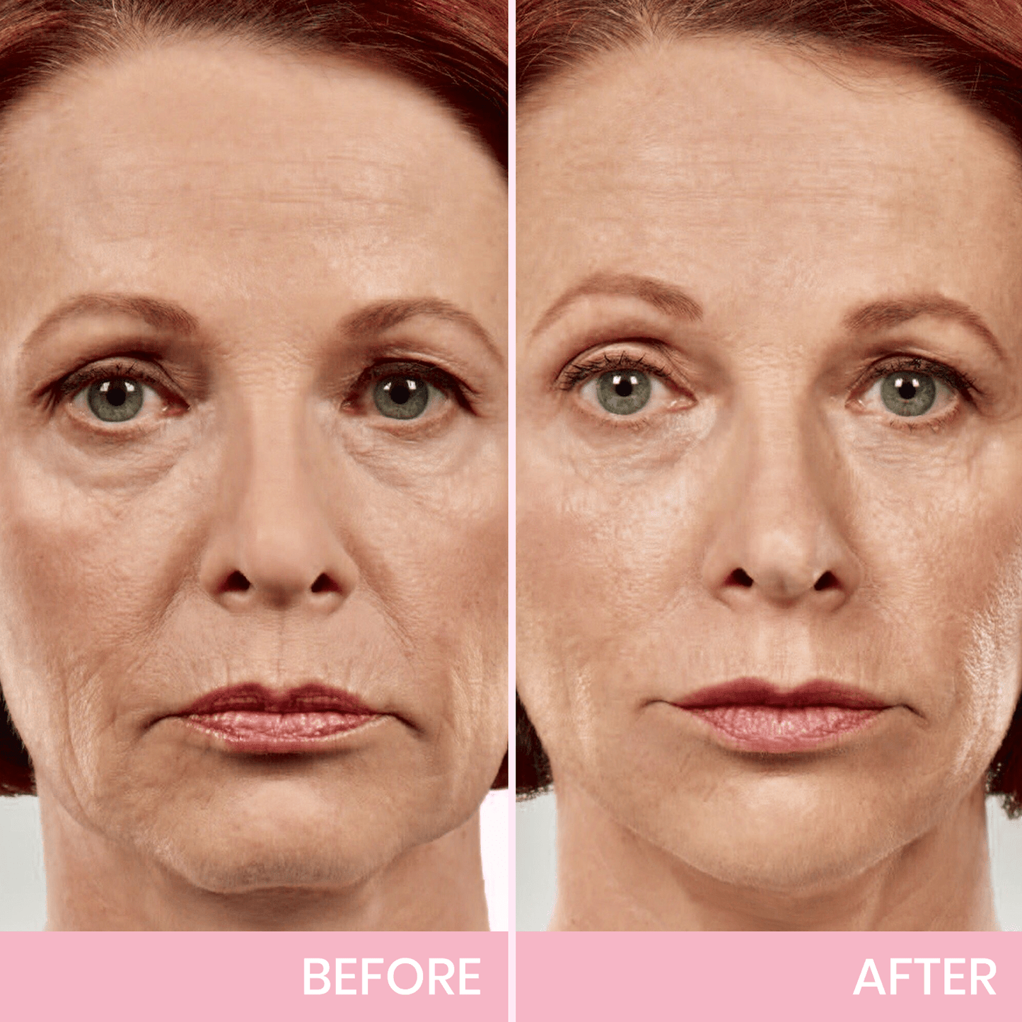 V-Gesicht 👑 Unsichtbares Lifting-Tape